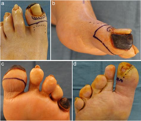 Figure 2 from Distal Syme Hallux Amputation for Tip of Toe Wounds and ...