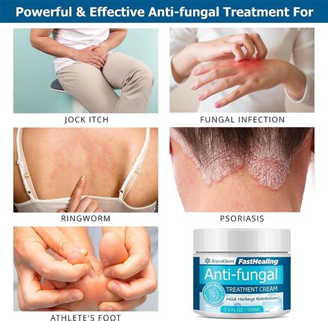 Roycederm Antifungal Cream - Maximum Strength Treatment for Athletes ...