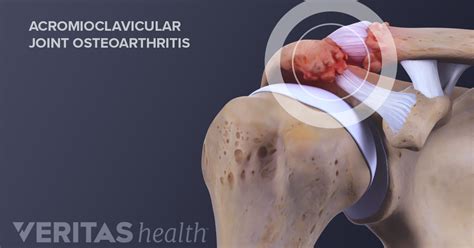 What Is Acromioclavicular Arthritis (AC Joint Arthritis)?