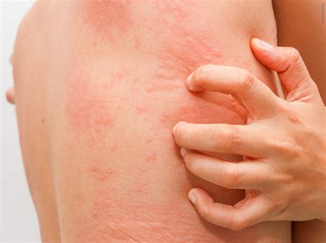 Urticaria - Causes, Symptoms, Treatment, Home Remedies