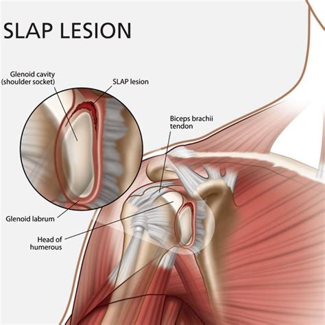 How To Fix A Shoulder Ligament Tear - Margaret Greene Kapsels