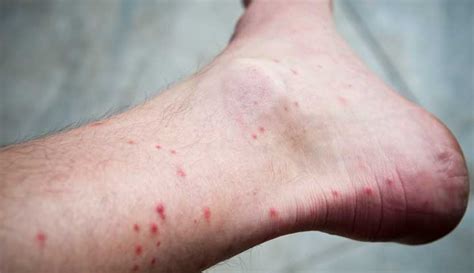 Flea Allergy Dermatitis On Humans