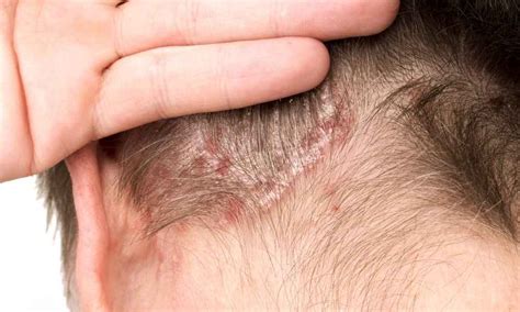 Penyakit Kulit Psoriasis – newstempo