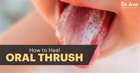 Thrush In The Mouth Treatment Mouthwash