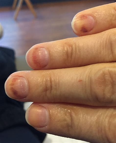 I Didn’t Expect THAT: Chemo Nails – Frantic Shanti