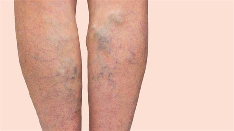 What Causes Varicose Veins? – Welling Homeopathy