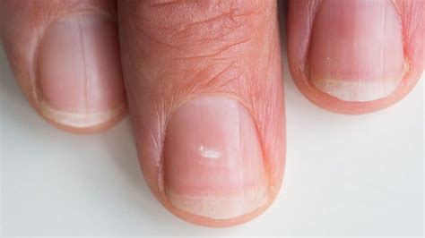 What Causes White Horizontal Lines On Fingernails - Design Talk