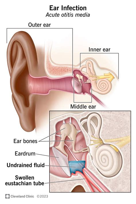 Ear Infection (Otitis Media): Symptoms, Causes & Treatment