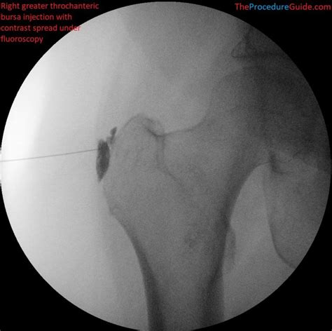 Fluoroscopic Guided Greater Trochanteric Bursa Injection – Technique ...