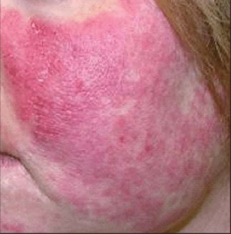 Acute cutaneous lupus erythematosus demonstrating the malar ...