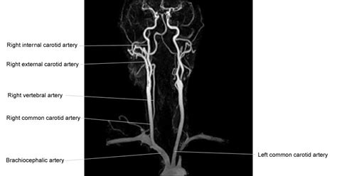 Radiology Anatomy Images : NECK CT ANGIOGRAM ANATOMY