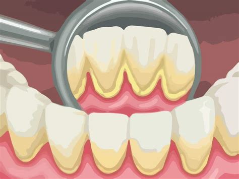 Dental plaque and tartar - How Deep Teeth Cleaning treats gum disease