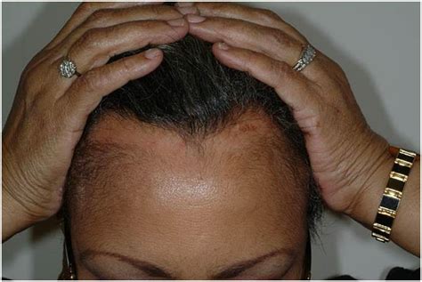 Frontal fibrosing alopecia | Download Scientific Diagram