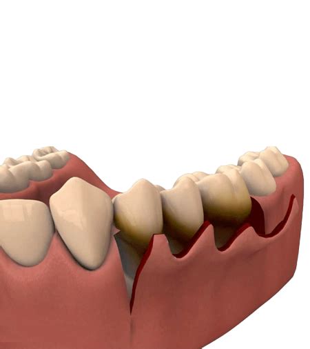 Flap Surgery & Gum Surgery in Hyderabad, India at FMS DENTAL