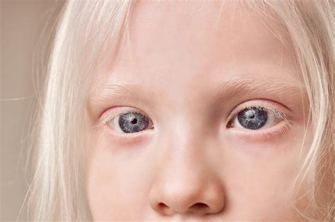 Albino Eye Color: Understanding Its Unique Appearance