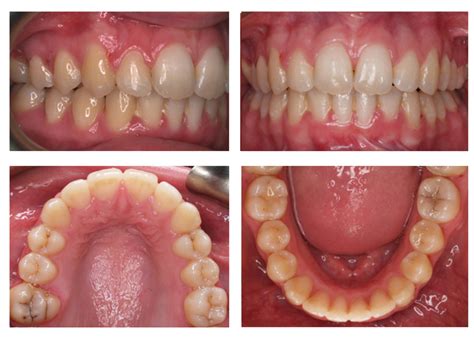 Teeth Before And After Braces Crowding