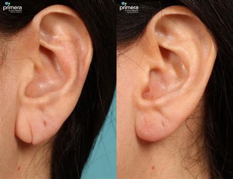 Ear Surgery (Otoplasty) Before and After Pictures Case 424 | Orlando ...