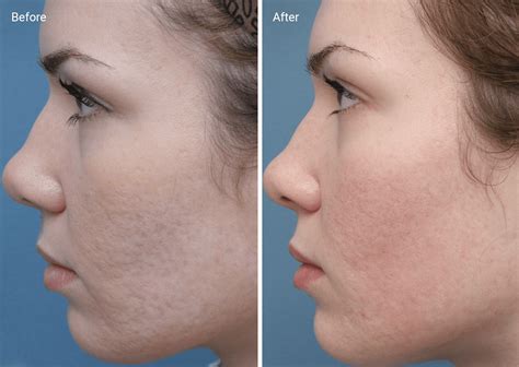 Chemical Peels for Acne Scars: Efficacy, Before and Afters, At-Home Uses