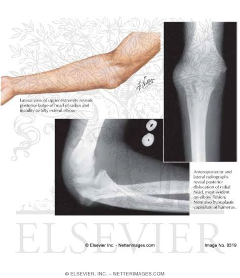 Congenital Dislocation of Radial Head