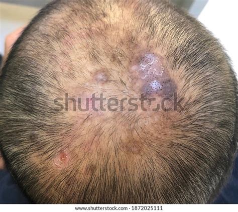 Multiple Ill-define Scarring Non-scarring Alopecia Scalp Stock Photo ...