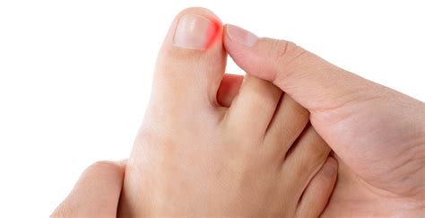 Ingrown Toenail Removal | Podiatrist NYC Downtown | Step Up Footcare