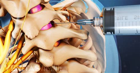 Epidural Injection Procedure