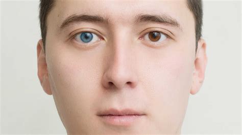 Heterochromia: Causes, Diagnosis and Treatment - accuspire