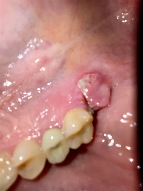 Ankylosed tooth extraction day 5. Is this normal healing? : r/askdentists