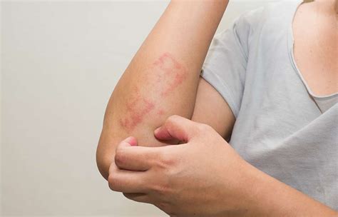 Penyakit Kulit Psoriasis – newstempo