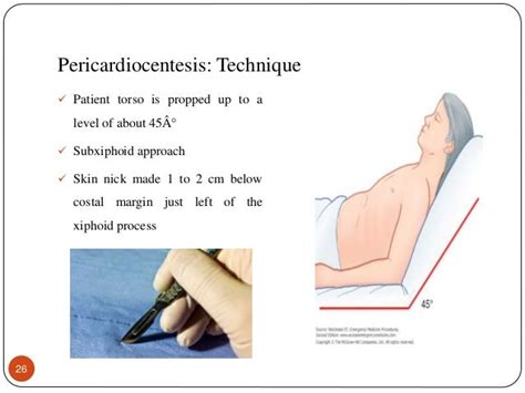 Pericardiocentesis