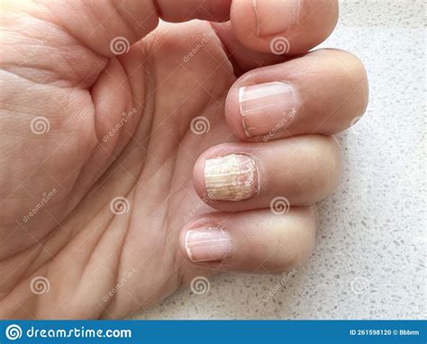 Closeup Hand of a Woman with Nail Fungus Stock Photo - Image of ...