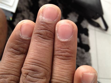 What Causes White Vertical Lines In Your Fingernails - Design Talk