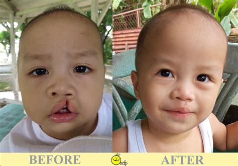 Gallery - Noordhoff Craniofacial Foundation Philippines, Inc. (NCFPI)