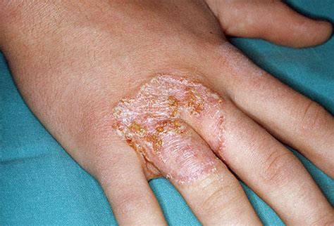 Hand Fungus: What Is It and How Is It Treated? | Healthcare-Online