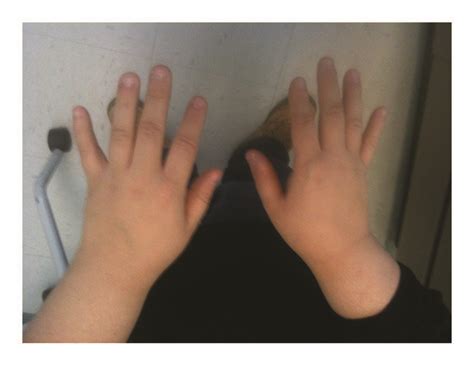 Small hands characteristic of Prader-Willi syndrome. | Download ...