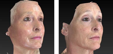 Before & After Laser Wrinkle Reduction in Fruitland Park FL | VIP