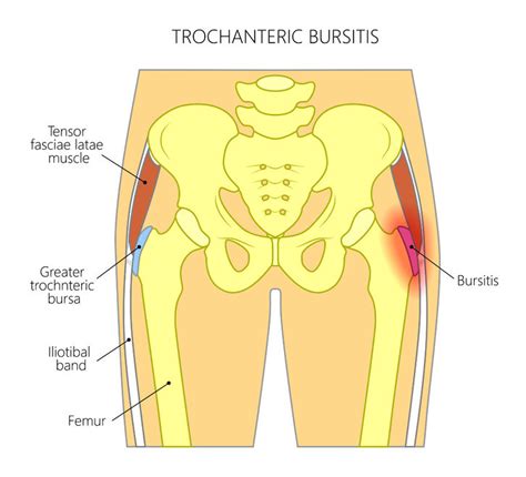 Hip Bursitis: The Importance of Early Diagnosis and Treatment ...