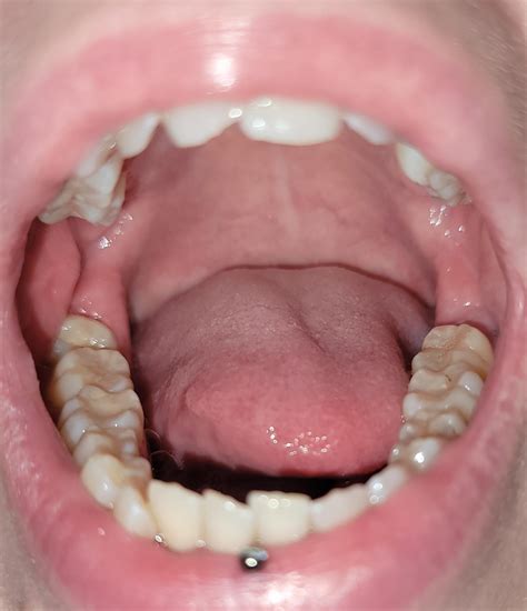 Painful and swollen cheek : r/askdentists