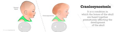 Craniosynostosis - Types, Causes, Symptoms, Diagnosis, Treatment ...