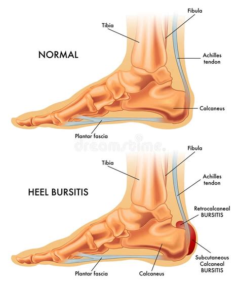 Ejemplo Médico De La Bursitis Trocantérica Ilustración del Vector ...