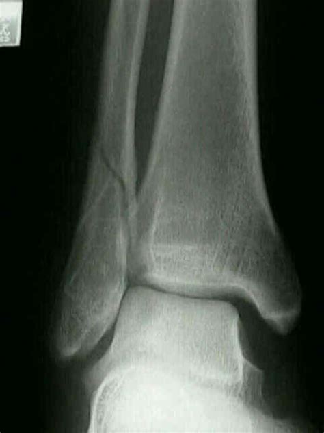 Weber B: Lateral Malleolus Frx : Wheeless' Textbook of Orthopaedics