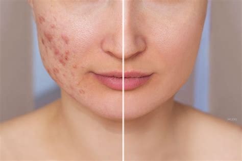 Severe Acne Scars Before And After