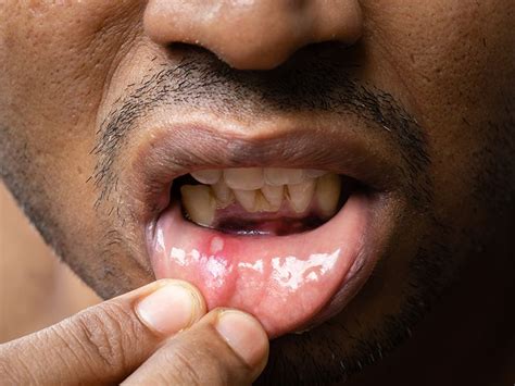 Mouth Sores: What They Look Like and What Can Cause Them