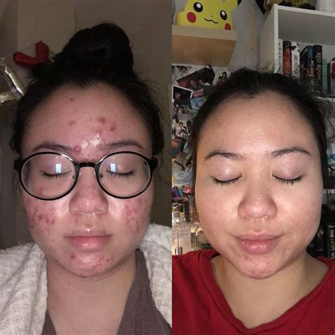 [Before&After] My Cystic Acne Journey! : r/SkincareAddiction