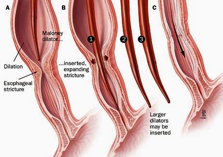 ENT Blogs: ESOPHAGEAL STRICTURE