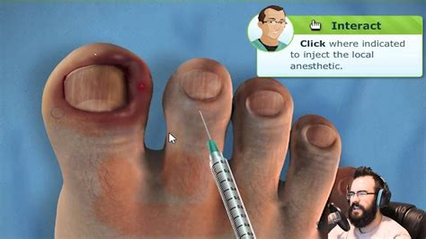 Ingrown Toenail Skin Removal - EXTREME INFECTED INGROWN TOENAIL REMOVAL ...