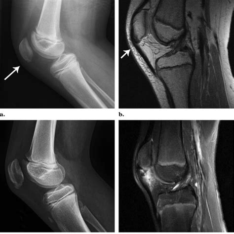 Patellar sleeve fracture in an 11-year-old boy who was injured when he ...