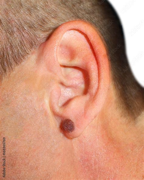 A man with a large mole on his ear. For medicine, the image of the ...