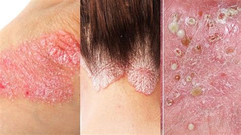 Penyakit Kulit Psoriasis – newstempo