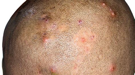 Folliculitis Scalp